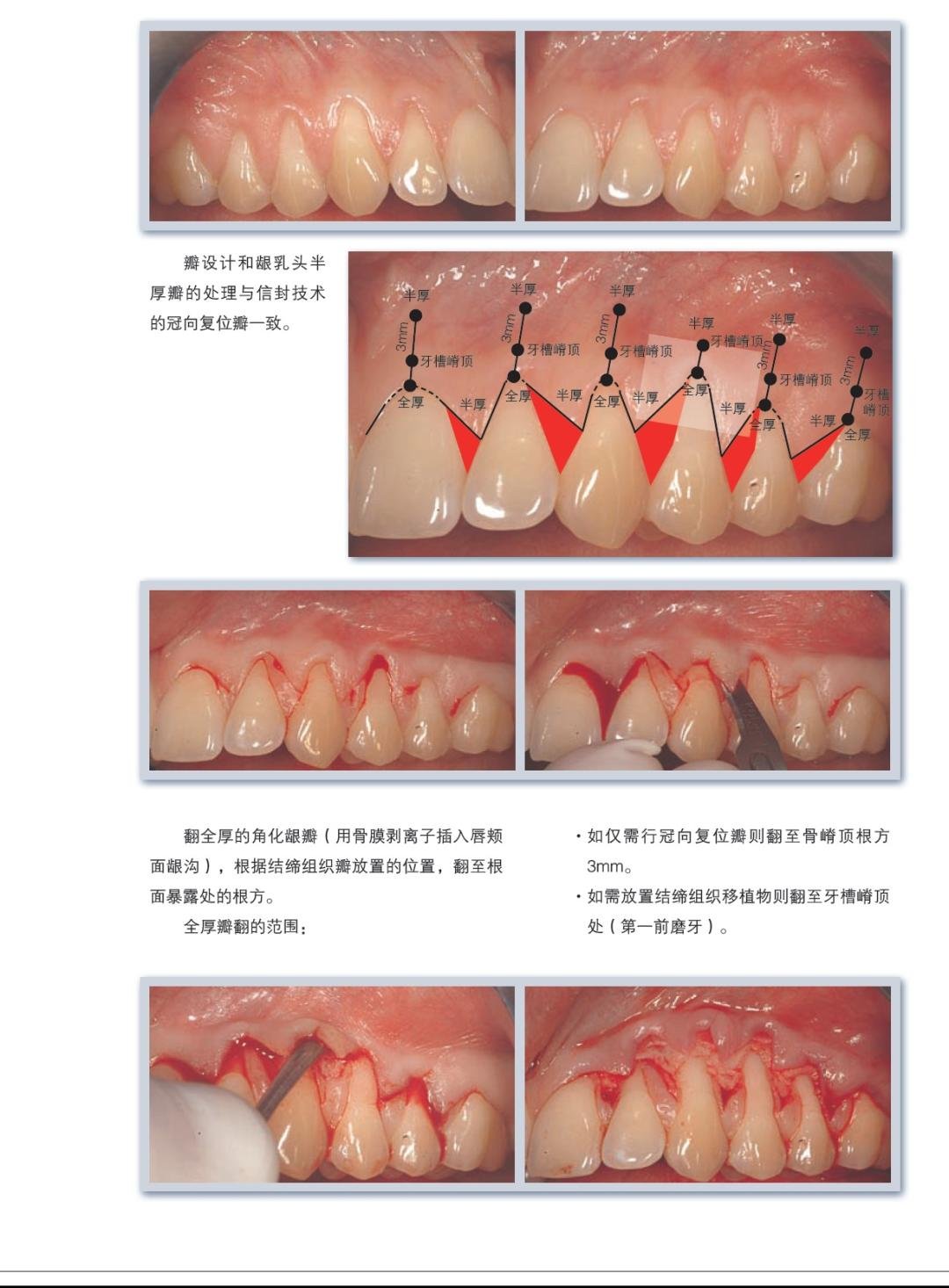 膜龈美学手术精要