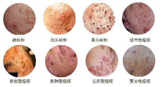 教你看清从湿热到青春痘转变