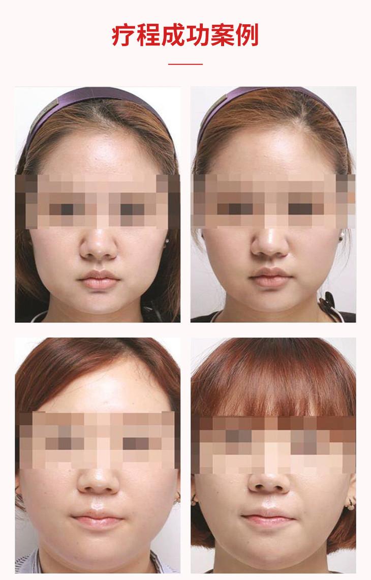 溶脂针击退脂肪重塑完美身型medikpro医疗两针