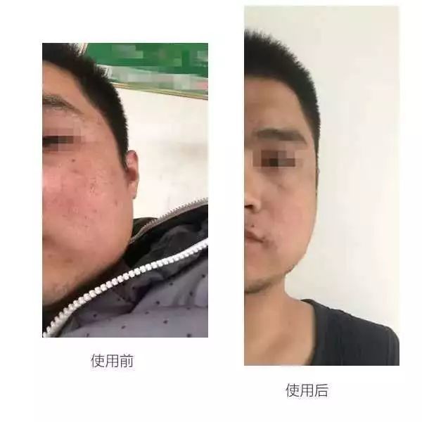 美国首博尔壬二酸清痘凝胶15g