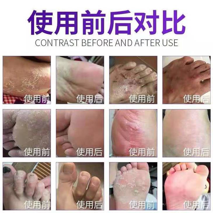 脚气主图7