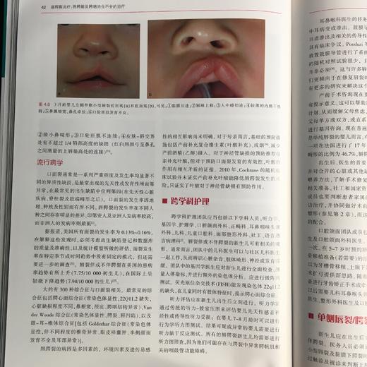 唇腭裂treatment唇腭裂及腭咽闭合不全的treatment