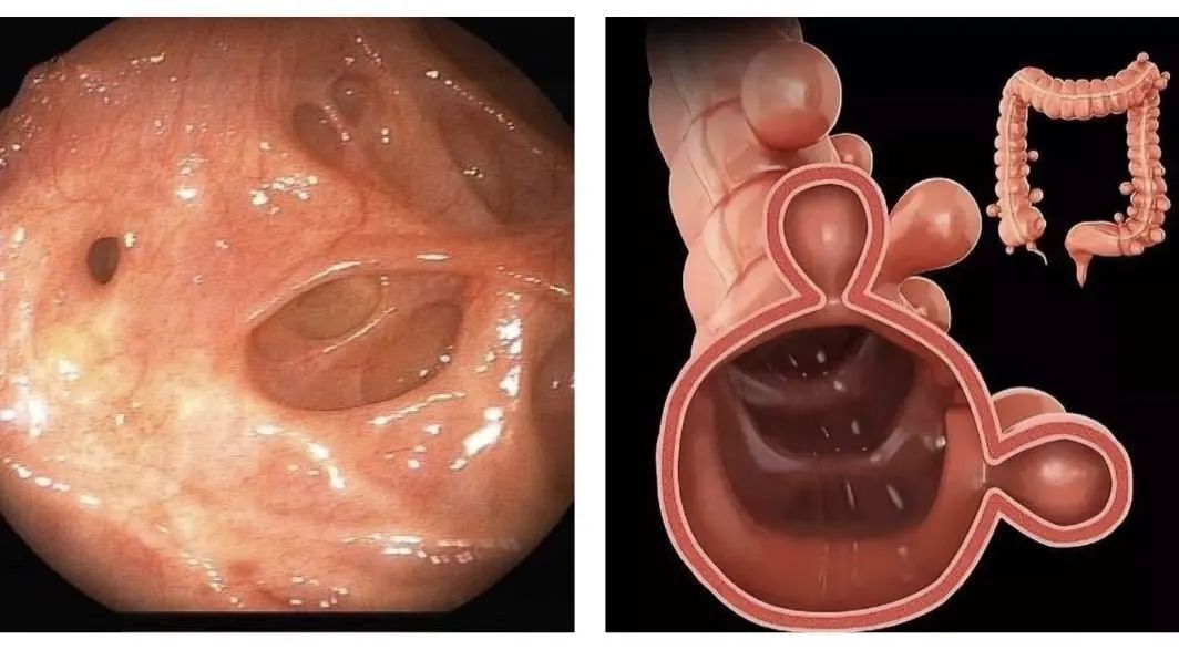 肠道由于便秘而产生的憩室】