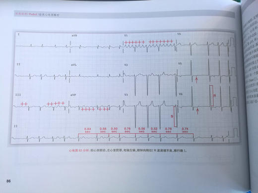 波德瑞德（Podrid）临床心电图解析 1-4卷（5分册） 商品图9