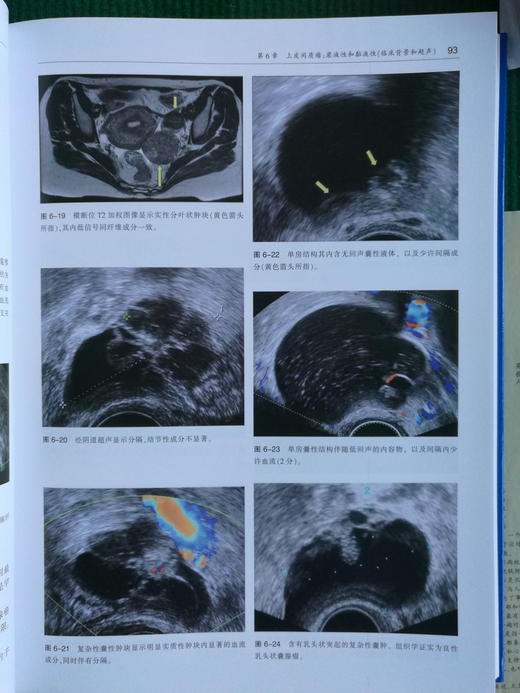 卵巢肿瘤影像学 商品图4