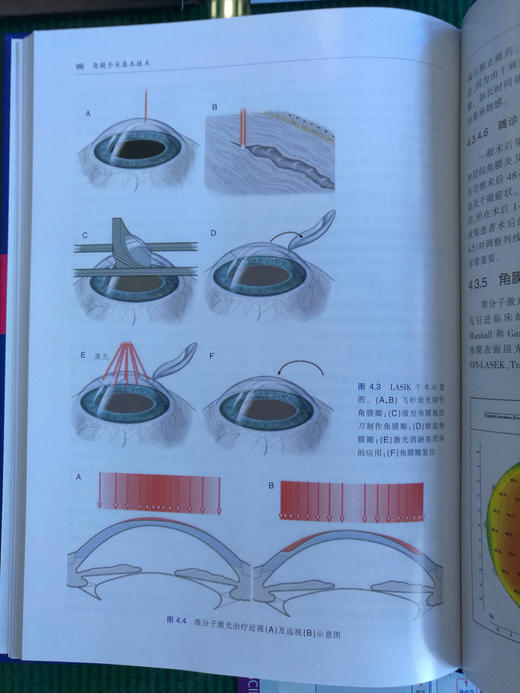 角膜手术基本技术（附赠原版DVD手术视频） 商品图9