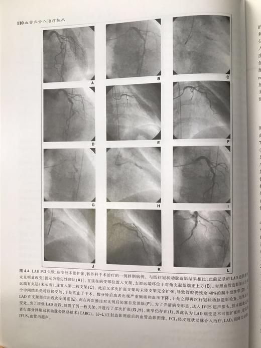 血管内介入治疗技术☆ 商品图4