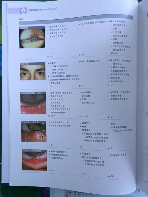 角膜接触镜并发症——诊断与treat 商品图3