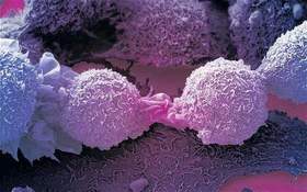 女性卵巢，万一癌变了怎么办？