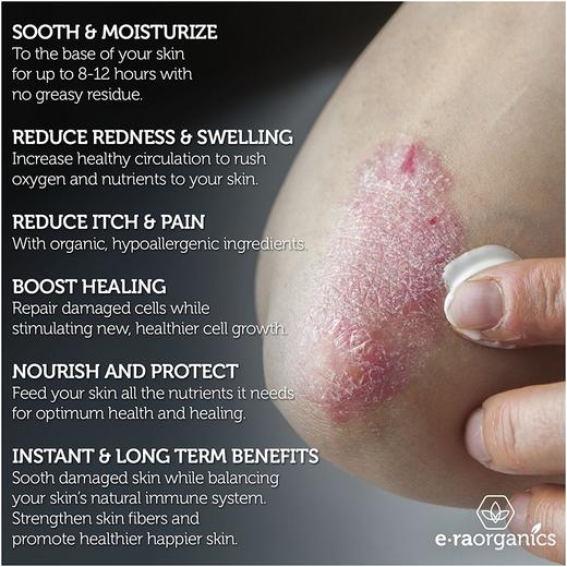 近5星好评！Era Organics 湿疹牛皮鲜克星乳霜118ml 商品图2