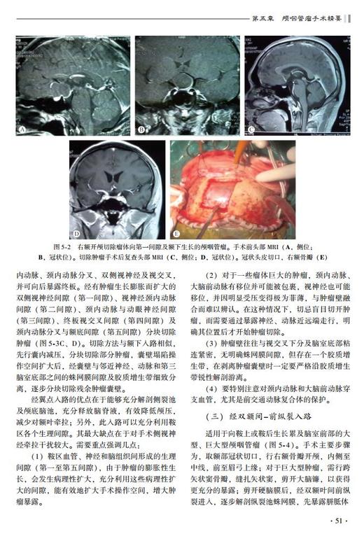 神经外科手术精要与并发症（第2版） 北医社 商品图6