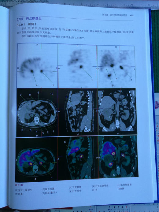 PET/MRI，PET/CT及SPECT/CT解剖图谱-☆ 商品图11