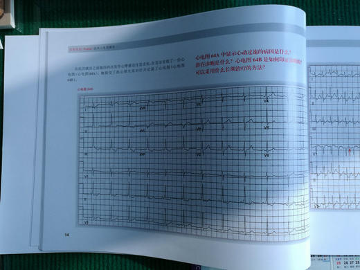 波德瑞德（Podrid）临床心电图解析（卷5B）：窄和宽QRS波心动过速实践病例 商品图4