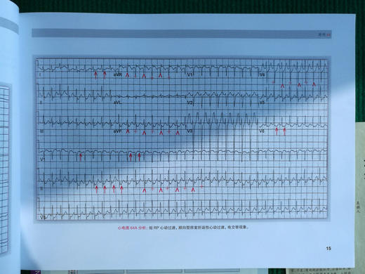 波德瑞德（Podrid）临床心电图解析（卷5B）：窄和宽QRS波心动过速实践病例 商品图5
