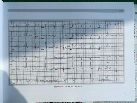 波德瑞德（Podrid）临床心电图解析（卷5B）：窄和宽QRS波心动过速实践病例 商品图8