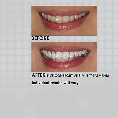 金盒特价！Pro Teeth Whitening Co 温和活性炭天然牙齿美白粉 商品图3