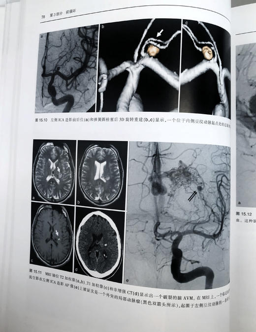 神经血管介入解剖—临床案例分析 商品图2