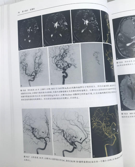 神经血管介入解剖—临床案例分析 商品图6