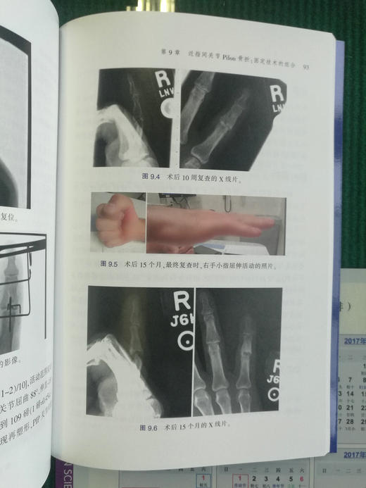 近指间关节骨折与脱位临床实用手册 商品图5