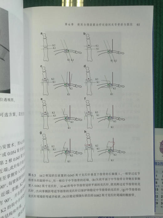 近指间关节骨折与脱位临床实用手册 商品图4