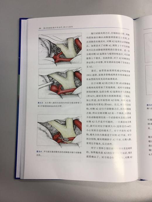 脑动脉瘤显微外科治疗：图示与病例 商品图6