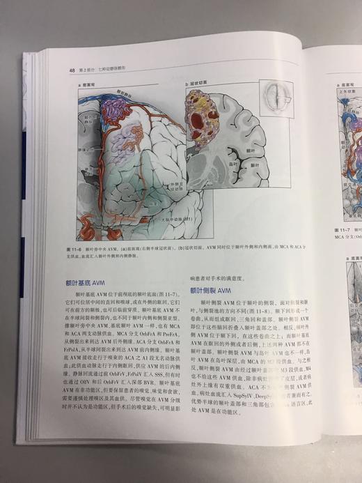 七种类型动静脉畸形 —手术策略及技巧 商品图8