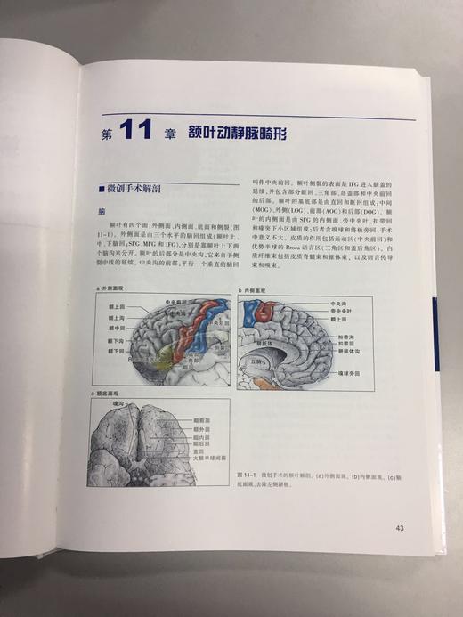 七种类型动静脉畸形 —手术策略及技巧 商品图3