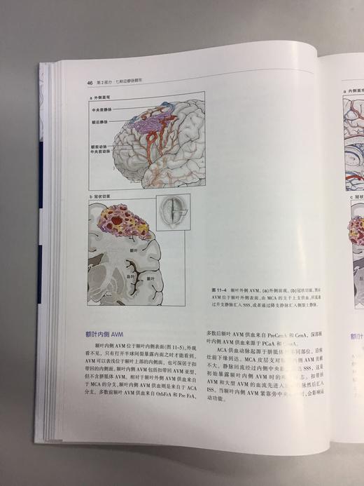 七种类型动静脉畸形 —手术策略及技巧 商品图6