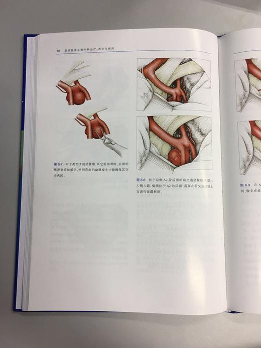 脑动脉瘤显微外科治疗：图示与病例 商品图8