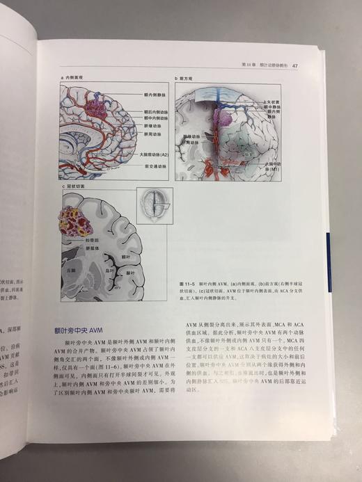 七种类型动静脉畸形 —手术策略及技巧 商品图7