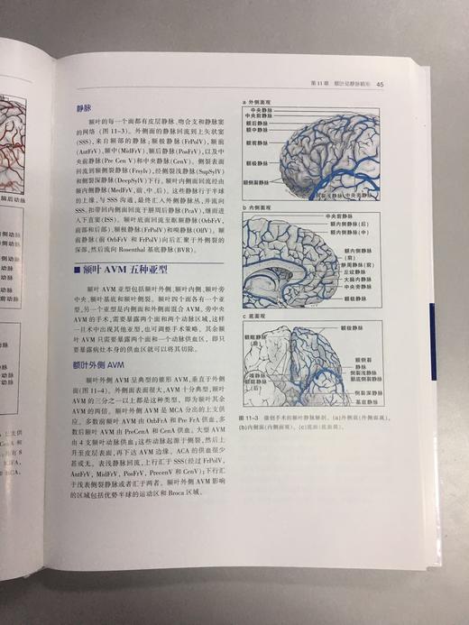 七种类型动静脉畸形 —手术策略及技巧 商品图5