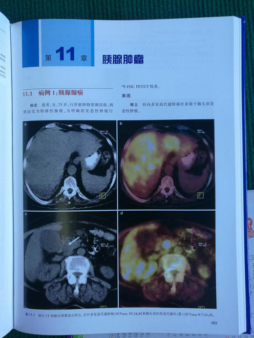 zhongliu PET/CT成像图谱：病例解析 商品图5