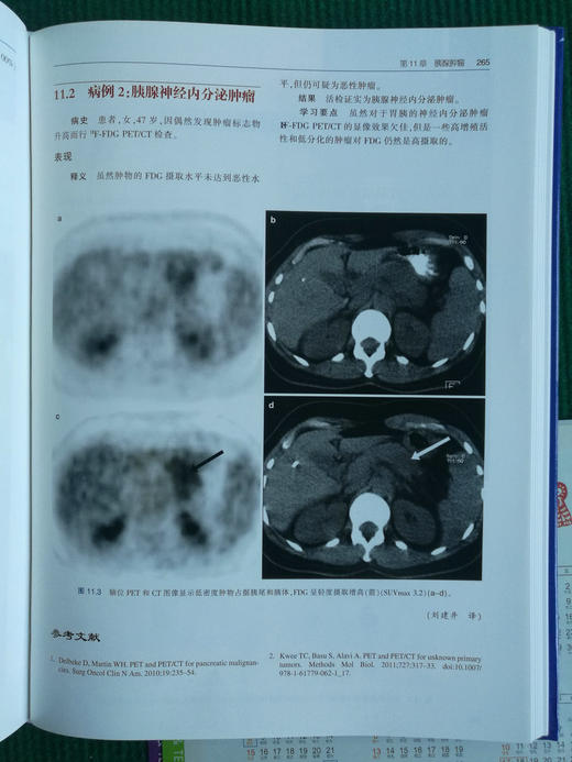 zhongliu PET/CT成像图谱：病例解析 商品图6