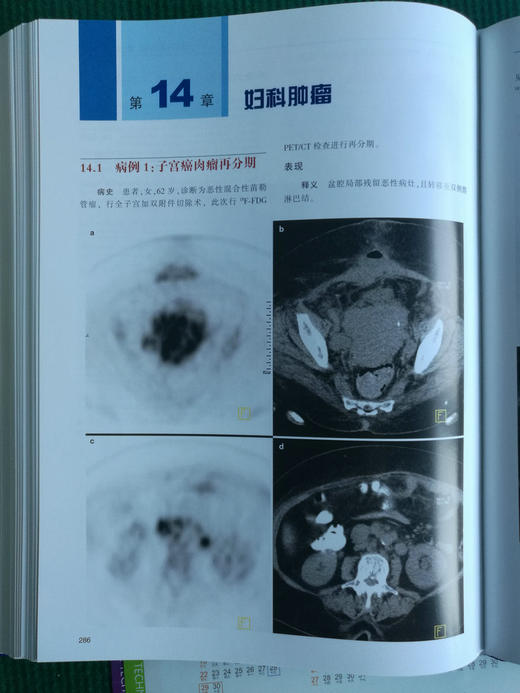 zhongliu PET/CT成像图谱：病例解析 商品图7