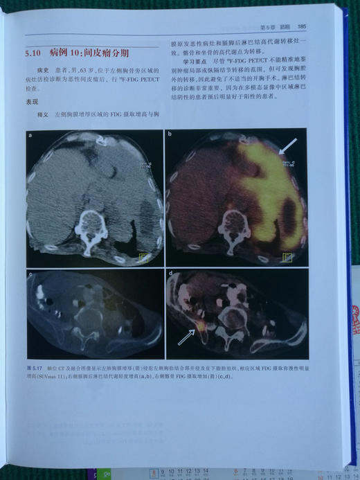 zhongliu PET/CT成像图谱：病例解析 商品图4