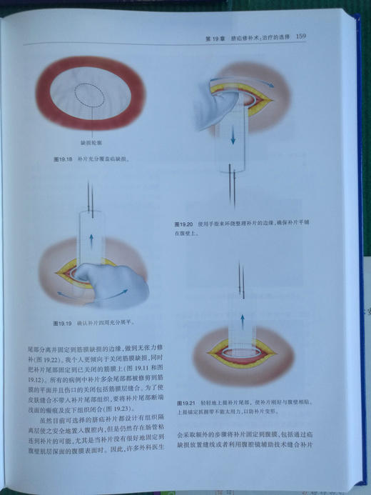 现代疝外科学：理论与技术 商品图8