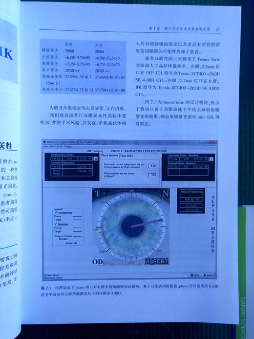 屈光手术疑难病例解析 商品图5