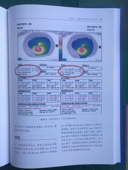 屈光手术疑难病例解析 商品图14