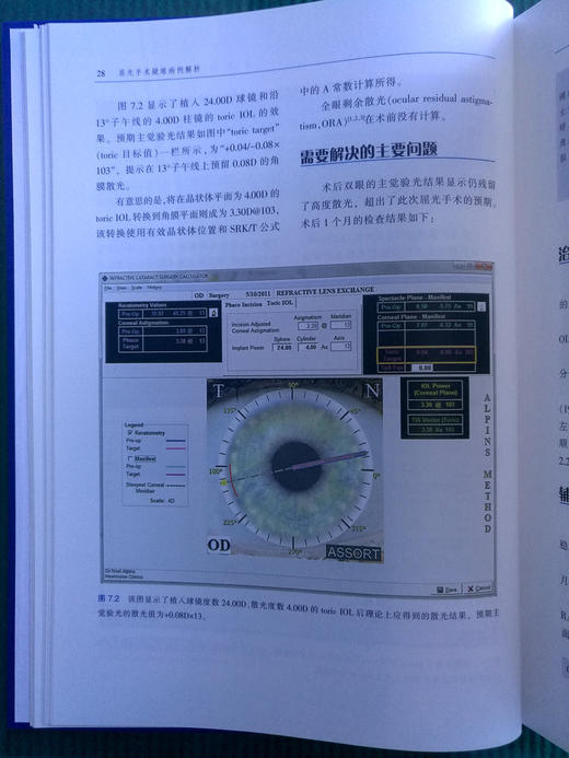 屈光手术疑难病例解析 商品图6