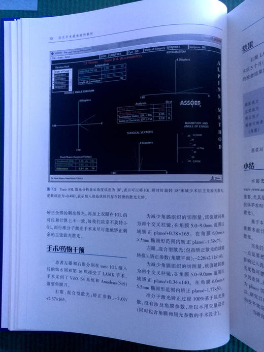 屈光手术疑难病例解析 商品图8