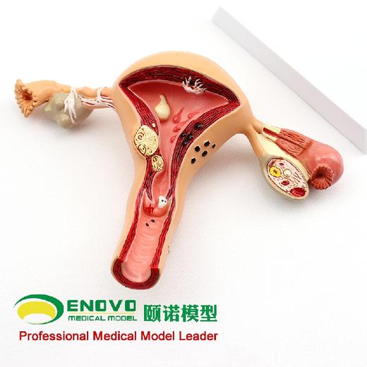刘宗印老师视频同款【医教模型】ENOVO颐诺人体 女性子宫卵巢阴道疾病模型  生殖科妇科医用医患模型 商品图1
