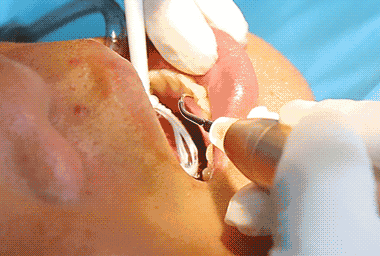 乐阳江58元牙周仪洗牙儿童窝沟封闭呵护牙齿