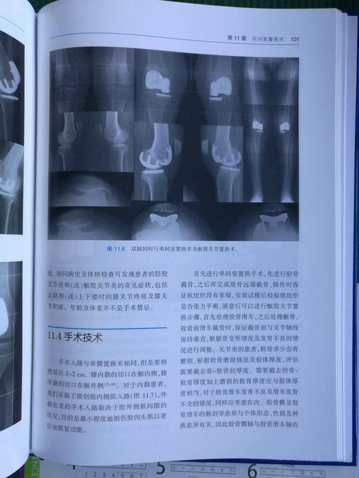 小假体在膝关节置换中的应用 商品图4