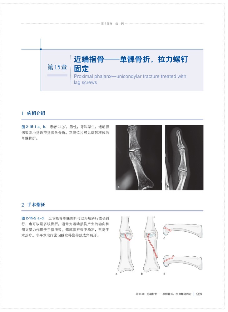 Ao手部骨折手术图解主译 刘璠陶然上科出版