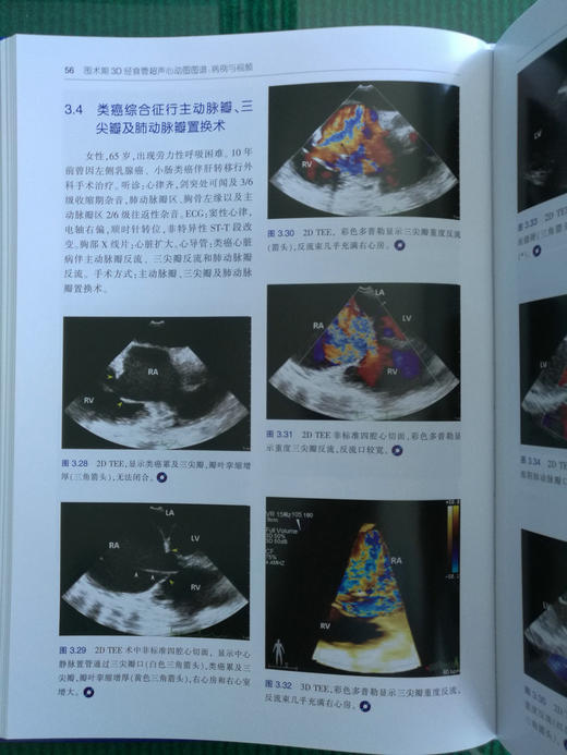 围术期3D经食管超声心动图图谱：病例与视频（天津科技翻译出版社） 商品图4