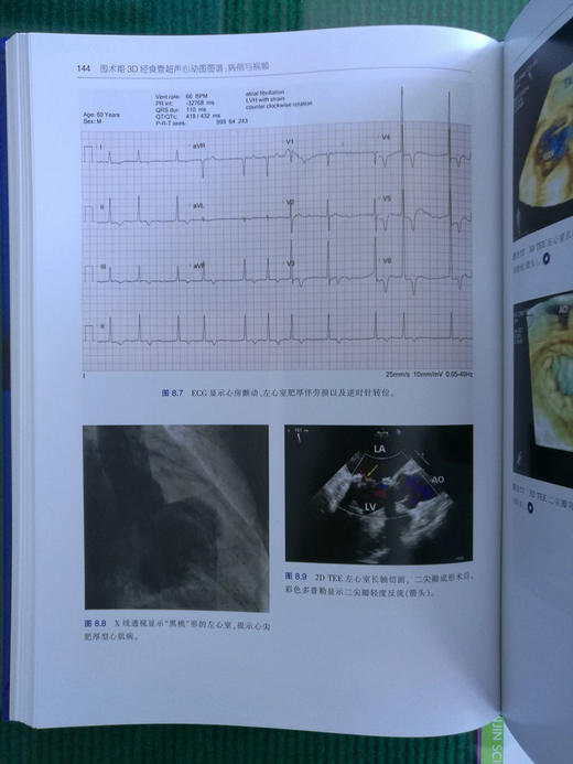 围术期3D经食管超声心动图图谱：病例与视频 商品图7