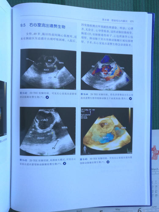 围术期3D经食管超声心动图图谱：病例与视频 商品图5