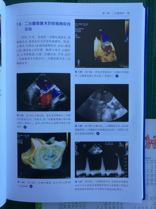 围术期3D经食管超声心动图图谱：病例与视频（天津科技翻译出版社） 商品图3
