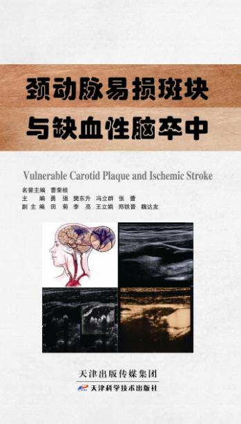 颈动脉易损斑块与缺血性脑卒中 商品图0
