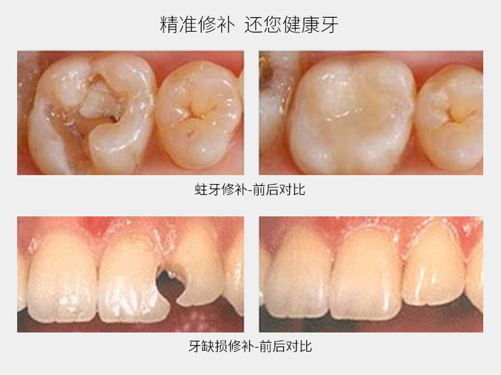 补牙进口通用树脂补牙套餐前后牙通用兰州牙科